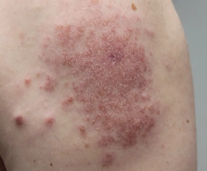 Sarcoidosis — dermatology condition treated at Uplift Wellness & Aesthetics